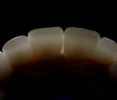 IPS e.max ZirCAD Prime features a smooth progression of shade and translucency.  Image: Aiham Farah