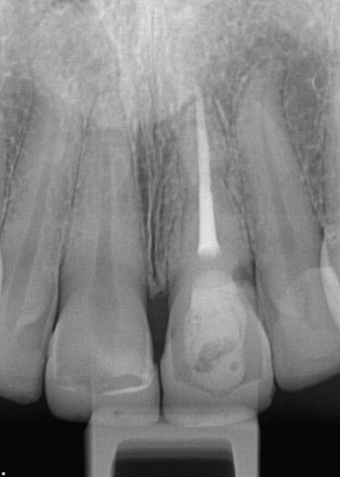 Fig. 8. Initial examination and x-rays revealed the root canal therapy with lingual composite filling.