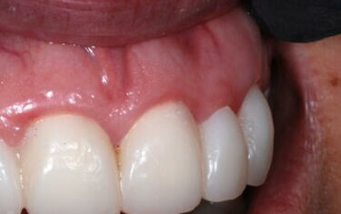 Healing Power: Cervitec Plus helps idealize gingival tissue health before  and after treatment.