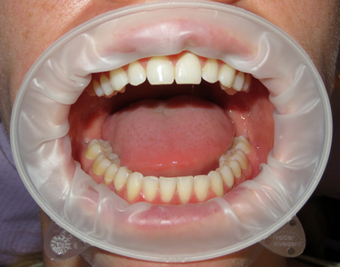 Figure 2: The patient was fitted with a latex-free lip and cheek retractor.