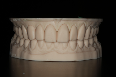 Fig 9. A 3D printed wax prototype of the proposed final outcome created by the laboratory maintained the natural shape of the patient’s teeth but added length and symmetry to enhance her smile.