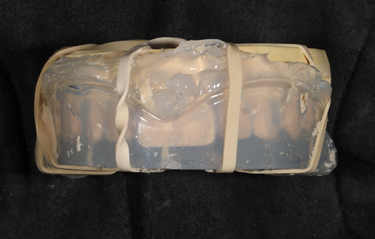 Figure 14. Injected wax into matrix formed from cast of provisional restorations.